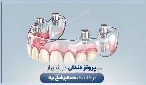پروتز دندان در شیراز